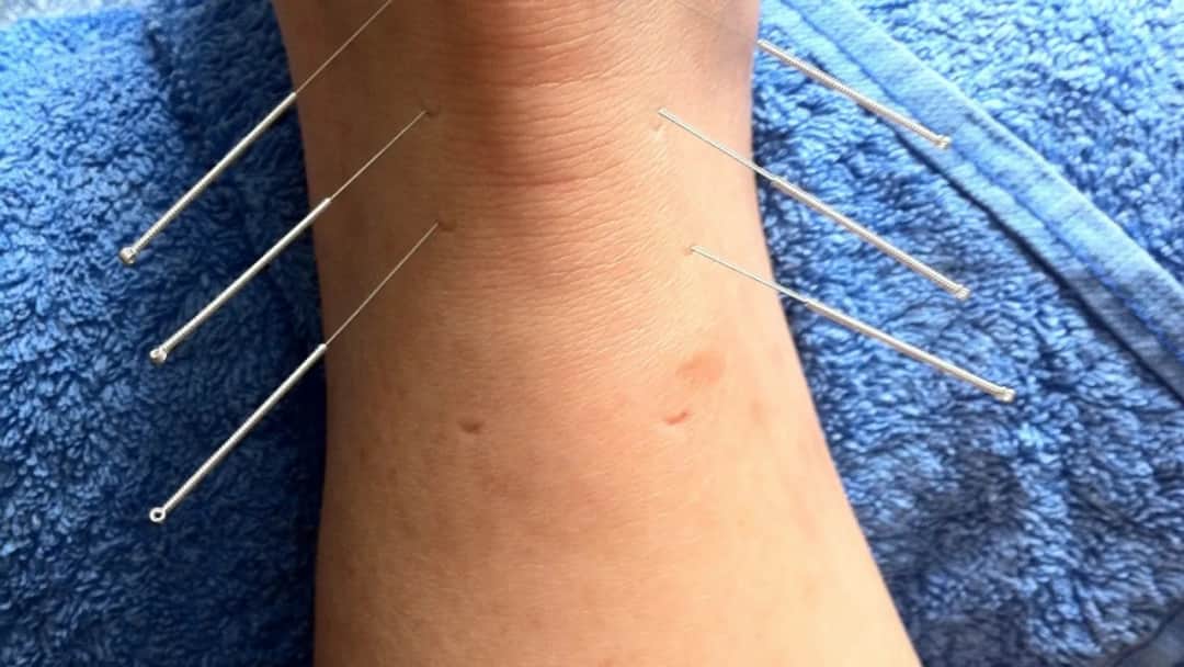 Igły do akupunktury: Jak wybrać najlepsze dla Twojego gabinetu?